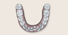 Invisilgn invisible braces can fix overly crowded teeth