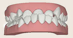 Invisalign invisible braces can fix underbite